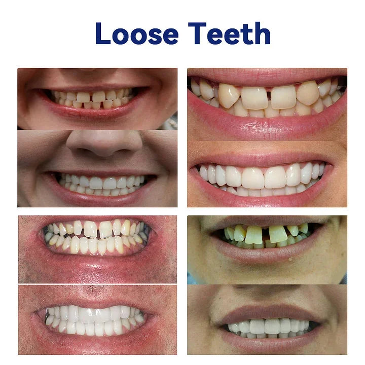 SmileFitPro™ – Lösung der neuen Generation: Flexible Vollprothese