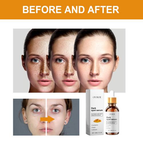 Serum gegen Pigmentflecken mit Kurkuma und Kojisäure