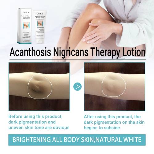 Urea & Milchsäure Körperlotion für raue Stellen