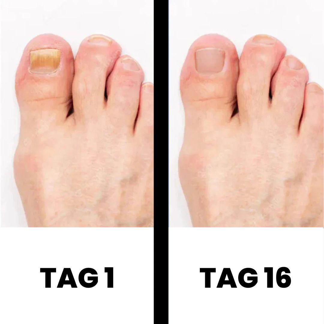 PureNail - patentierte Nagelpilz-Therapie - für gesunde Nägel innerhalb von 4 Wochen