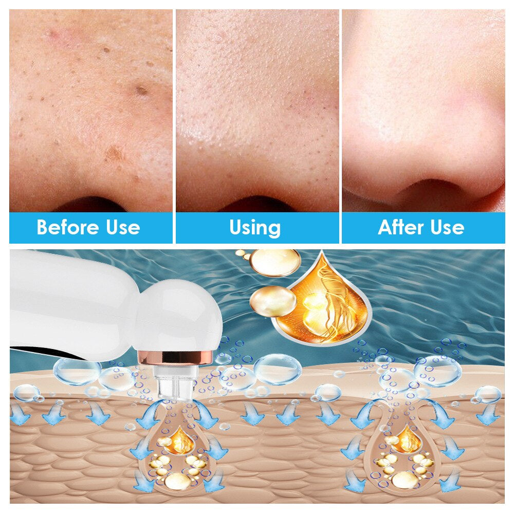 corlado | Hydrodermabrasion Mitesserentferner