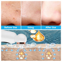 corlado | Hydrodermabrasion Mitesserentferner