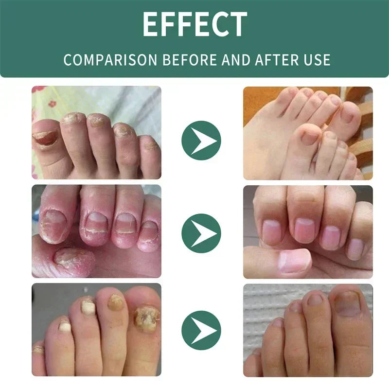 corlado | Nagelpilz Verteidiger Serum