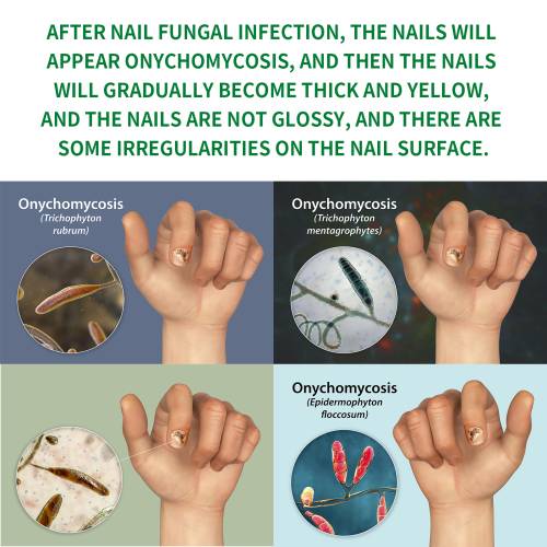 Ingwer Nagelpflege-Lösung